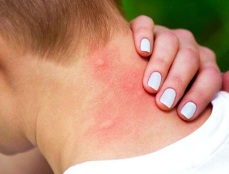 Picada de mosquito: o que fazer para parar de coçar?